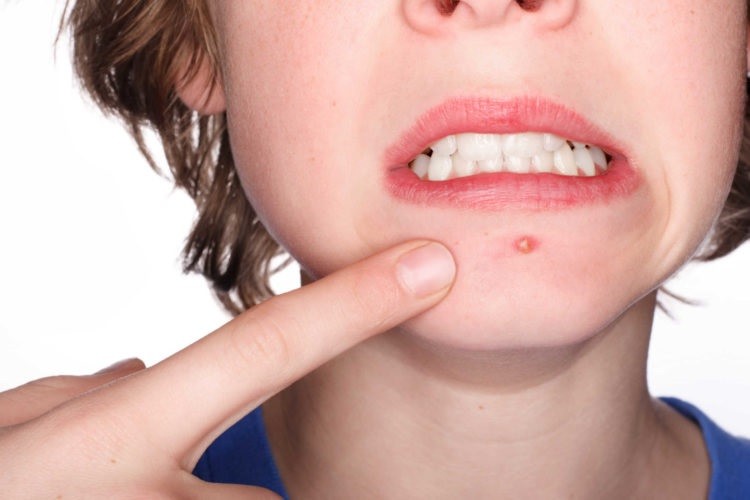 Cách trị mụn ở tuổi dậy thì hiệu quả