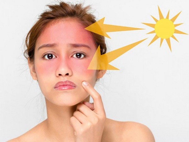 Da mặt bị cháy nắng thì phải làm sao? Cách chữa da bị cháy nắng hiệu quả