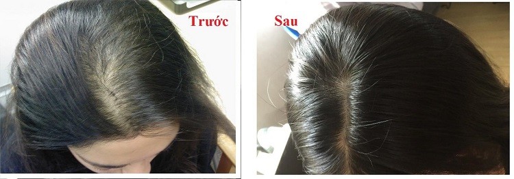 bonihair giá, bonihair amazon, bonihair in usa, bonihair chính hãng, bonihair mua ở đâu, bonihair canada, bonihair reviews, bonihair review, bonihair 60 viên, bonihair giá bao nhiêu, bonihair gia ban bao nhieu, thuốc bonihair, bonihair price, bonihair của mỹ, bonihair bao nhiêu tiền, thuốc bonihair giá bao nhiêu, giá thuốc bonihair, boni hair cupar, bonihair ban o dau, thuốc mọc tóc bonihair, thành phần thuốc bonihair, bonihair là gì, thuốc bonihair mua ở đâu, thuốc bonihair bán ở đâu, giá lọ thuốc bonihair, giá bán thuốc bonihair, bonihair gia bao nhieu tien, bonihair at walmart, giá bán bonihair, bonihair co hieu qua khong, tích điểm bonihair, mua bonihair, mua bonihair o dau, sản phẩm bonihair, viên uống bonihair, thuốc bonihair của mỹ, review thuốc bonihair, thuốc uống bonihair, cách sử dụng thuốc bonihair, đánh giá thuốc bonihair, công dụng thuốc bonihair, sự thật về thuốc bonihair, bonihair bán ở đâu tphcm, bonihair có giá bao nhiêu, bonihair cong dung, bonihair catalase, cách dùng bonihair, thao duoc boni hair, bonihair lừa đảo, bonihair ebay, đánh giá bonihair, bonihair la thuoc gi, mua bonihair o tphcm, bonihair nha thuoc viet, bonihair nha thuoc, uống bonihair bao lâu có tác dụng, cách uống bonihair, bonihair 30v,