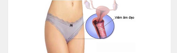 Viêm âm đạo