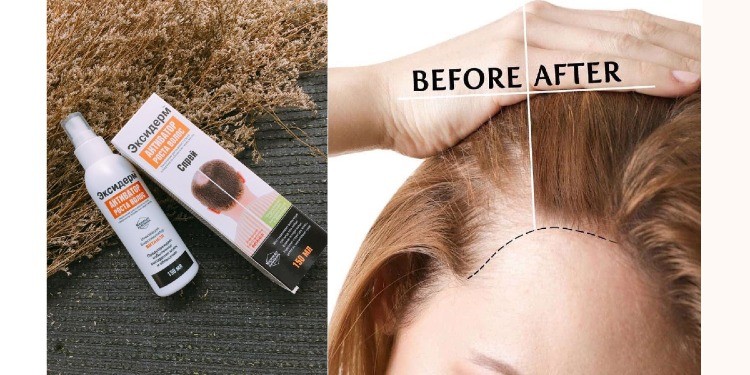 Rụng tóc gây ra những mảng hói trên da đầu khiến nhiều người mất tự tin và ngại ngần trong giao tiếp