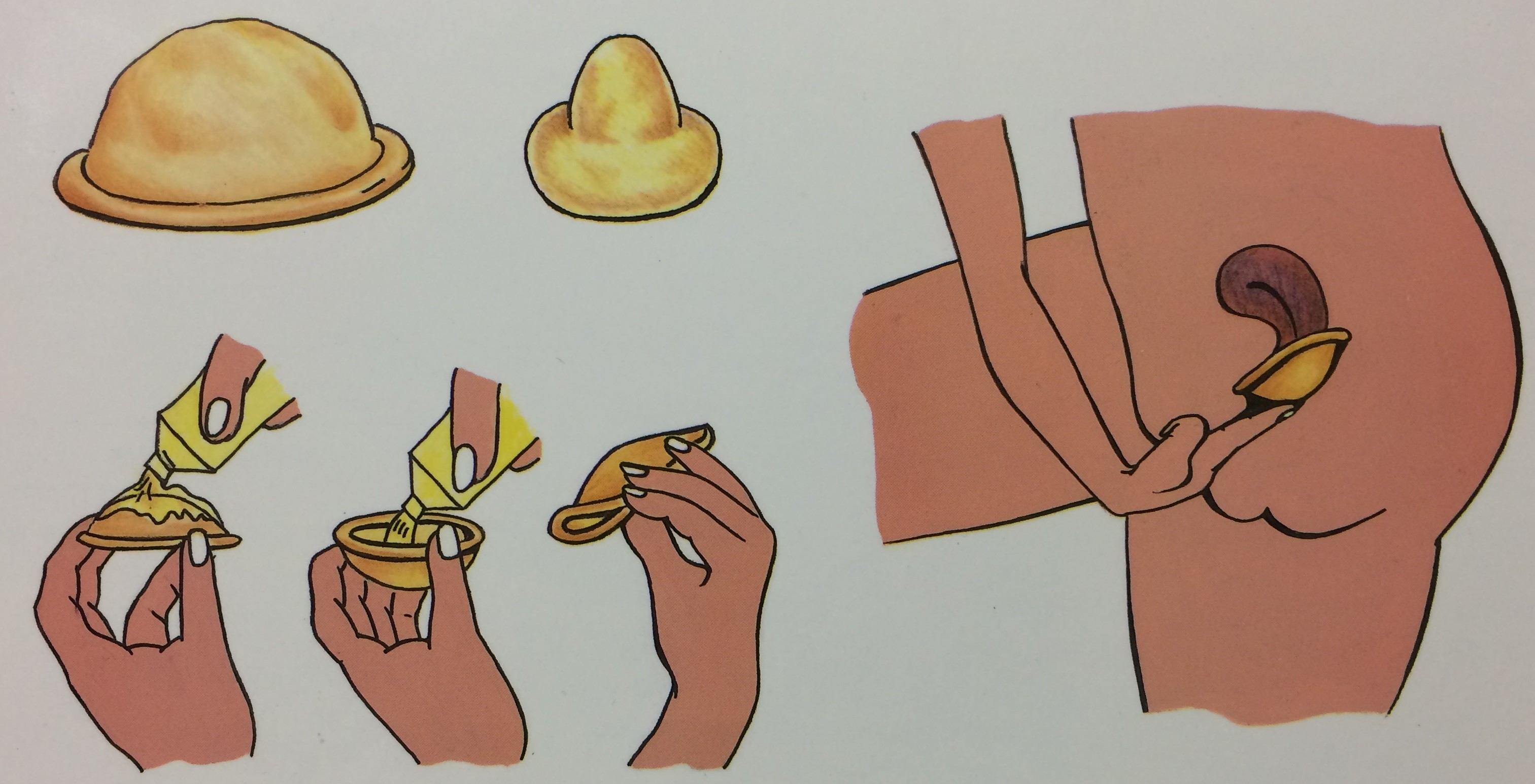 Nắp chụp cổ tử cung sử dụng được trong vòng 6 – 48 giờ