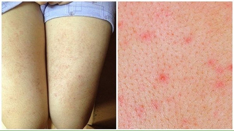 nguyên nhân gây viêm nang lông