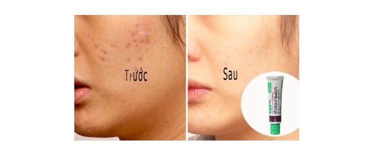 Kem kem trị sẹo gentacin, kem trị sẹo gentacin của nhật, kem trị sẹo gentacin review, kem trị sẹo gentacin của nhật review, kem trị sẹo gentacin của nhật có tốt không, kem trị sẹo gentacin nhật review, kem trị sẹo gentacin có tốt không, kem trị sẹo gentacin 10g nhật bản, review kem trị sẹo gentacin sheis, kem trị sẹo gentacin của nhật giá bao nhiêu, kem trị sẹo gentacin sheis, kem trị sẹo gentacin 10g, cách dùng kem trị sẹo gentacin, cách sử dụng kem trị sẹo gentacin, kem trị sẹo gentacin giả, kem trị sẹo gentacin webtretho