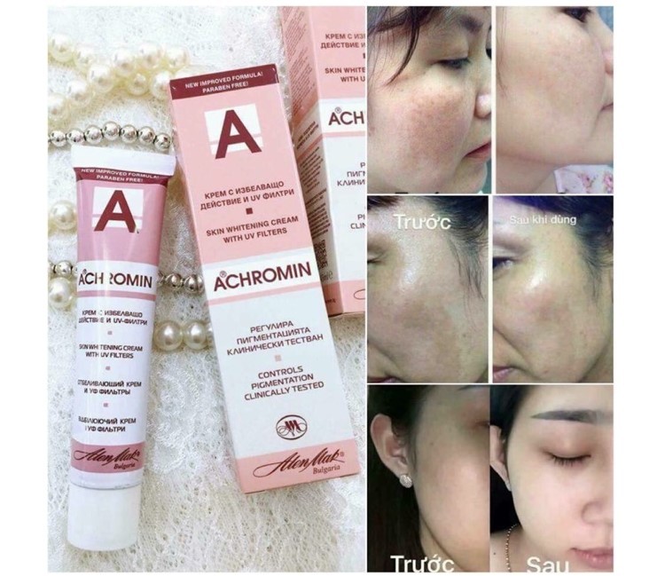 Kem trị nám Achromin của Nga review từ người dùng kem trị nám Achromin của Nga review, review về kem trị nám Achromin, kem trị nám Achromin giả, mua kem trị nám Achromin ở đâu, review kem trị nám Achromin, kem trị nám Achromin của Nga có tốt không, kem trị nám Achromin có tốt không, cách dùng kem trị nám Achromin, kem trị nám Achromin giá bao nhiêu, cách sử dụng kem trị nám Achromin